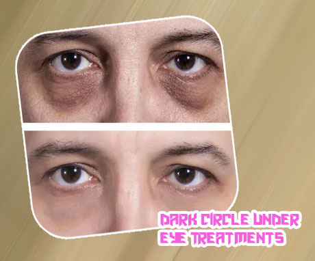 Under eye dark circle treatment